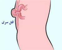 الفتق وأنواعه وأعراضه وكيفية الوقاية والعلاج