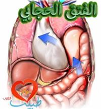 فتق الحجاب الحاجز ، الفتق الحجابي