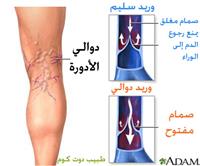 علاج دوالي الساقين بالليزر دون تدخل جراحي