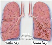 داءُ الرئة الخلاليّ المُصحُوب بالتهاب القُصيبات 