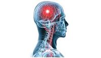 تمدد الأوعية الدموية الدماغي
