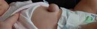 فتق السرة