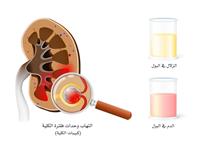 الاضطرابات الخِلقيَّة في نُبَيبات الكُلى