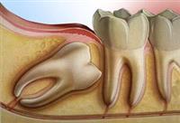 ضرس العقل بديل عن الأسنان المفقودة