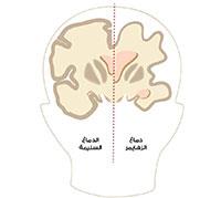  مرض الزهايمر 